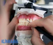 Seši zobu protēžu veidi, kas izskatās kā dabīgie zobi